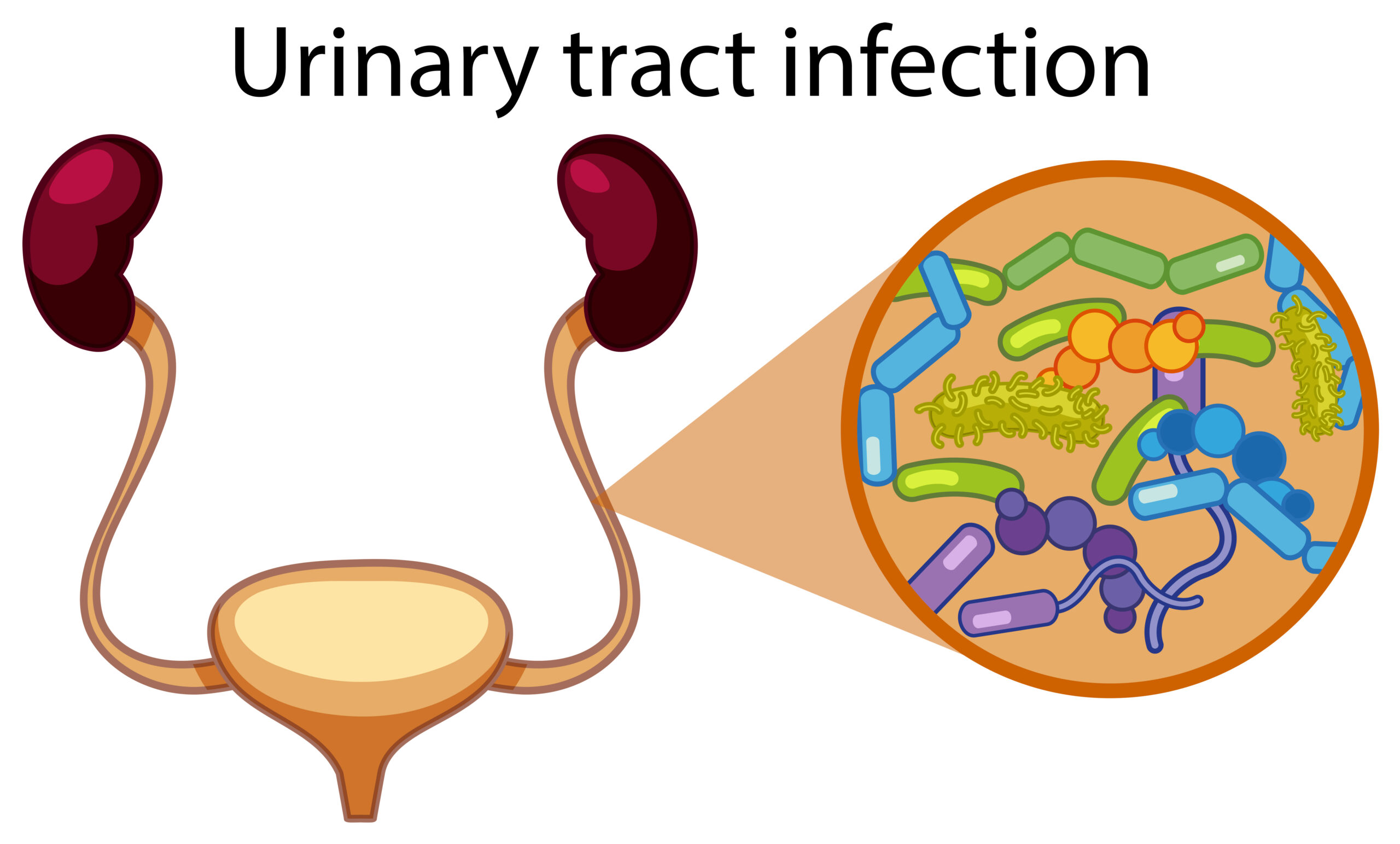 urinary tract infection